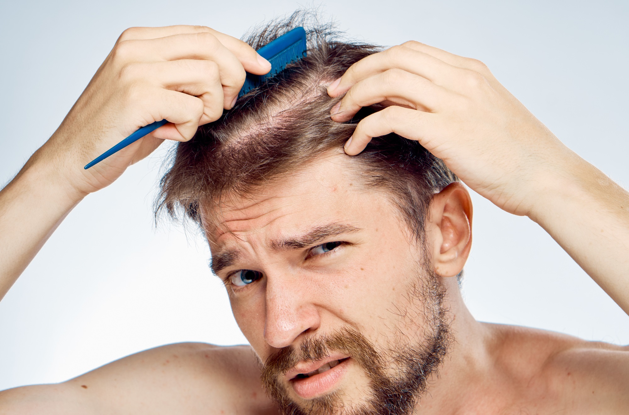 Scientists Have Made a Breakthrough Towards Curing Baldness